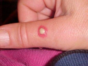 Marca de mordedura de araña en la mano humana