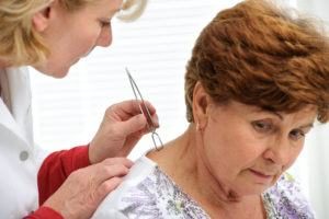 El médico que quita la garrapata con las pinzas de la piel del paciente