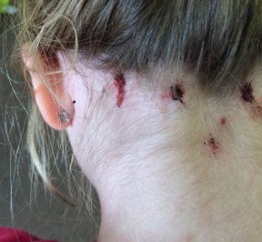 mosquito de búfalo muerde el cuello humano